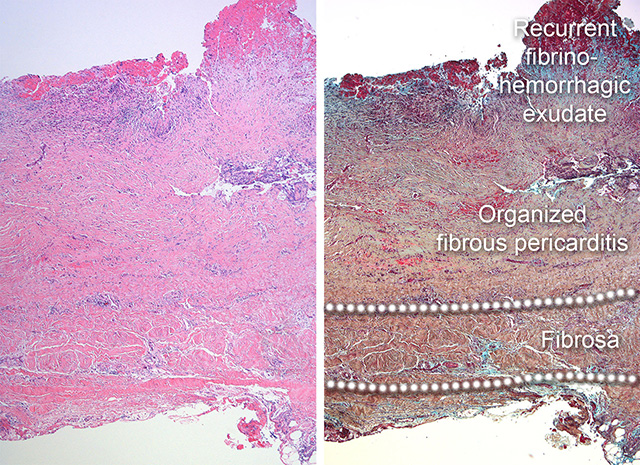 Organizd pericarditis micro H&E and Movat